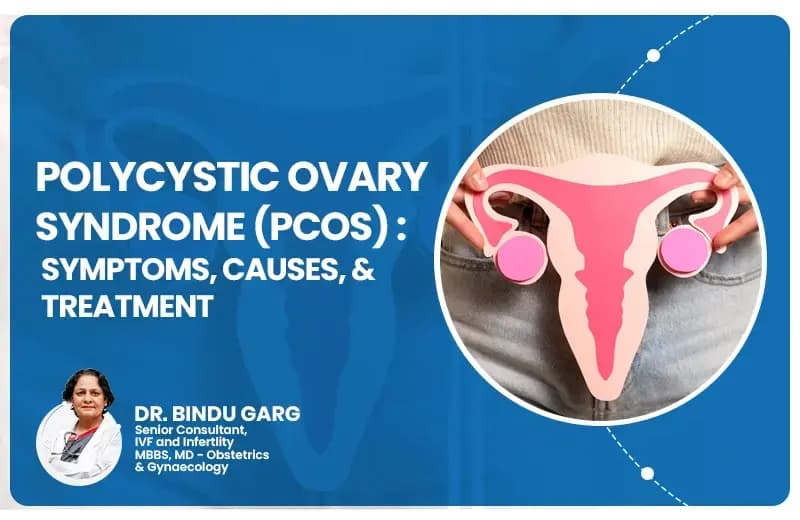 Polycystic Ovary Syndrome (PCOS): Symptoms, Causes, and Treatment